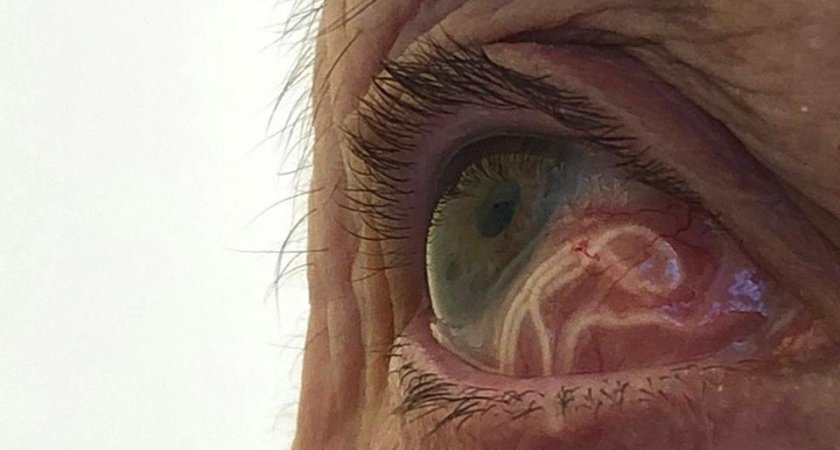 В Рязани провели операцию женщине с червями в глазу