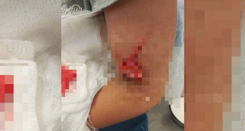 На горке в рязанском Лесопарке из-за отлетевшей заглушки ребёнок получил травму