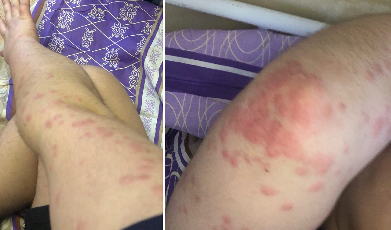 Руки и ноги в укусах: пациент ОКБ снял на фото последствия встречи с больничными клопами